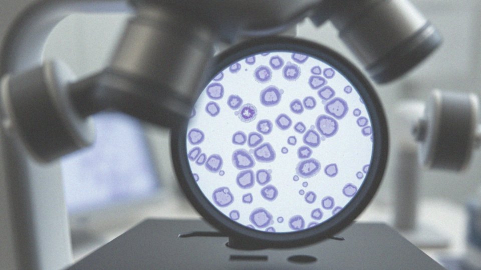 Co to jest stopień złośliwości histologicznej nowotworu?